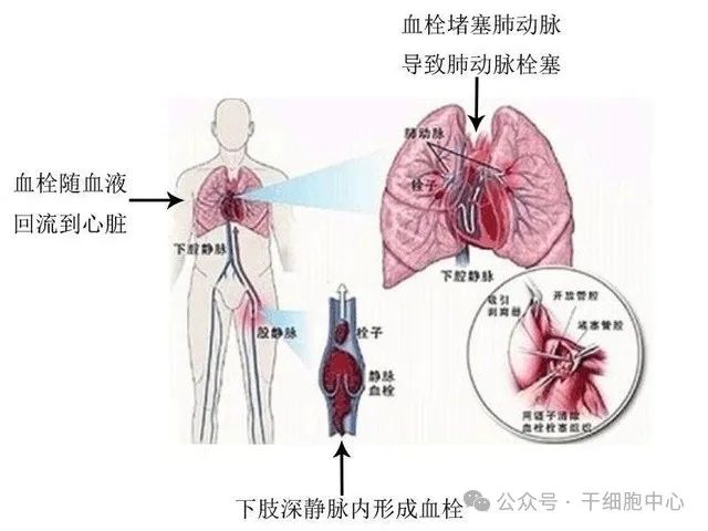 血栓最容易堵在身体3个地方！这4个奇怪的信号都在表明: 你的身体藏有血栓; 血管堵住了