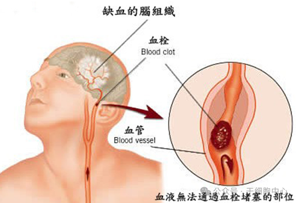 血栓最容易堵在身体3个地方！这4个奇怪的信号都在表明: 你的身体藏有血栓; 血管堵住了