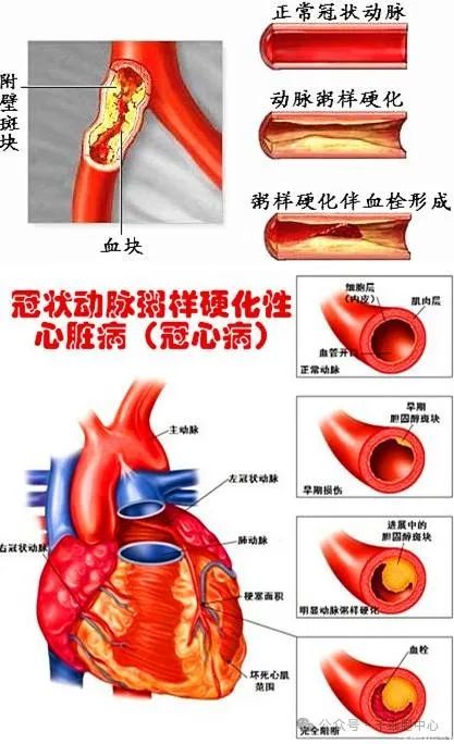 血栓最容易堵在身体3个地方！这4个奇怪的信号都在表明: 你的身体藏有血栓; 血管堵住了