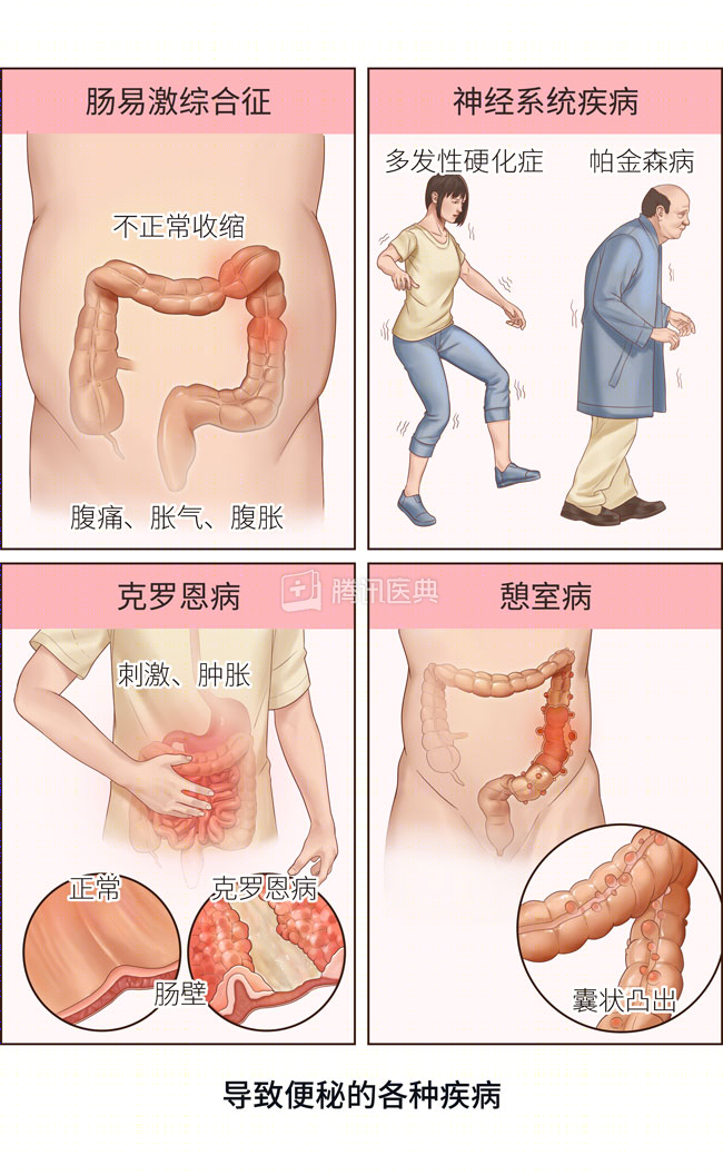 便秘3天，衰老3岁？医生：真的！但这样做能避免