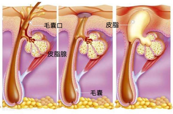 口罩之下痘频生，防疫抗痘怎两全？