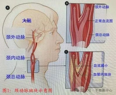 脑梗的十大征兆